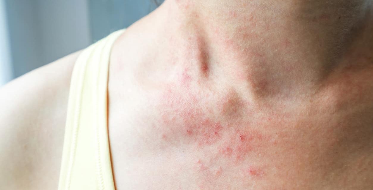 Penyakit Seks Yang Begitu Parah HIV