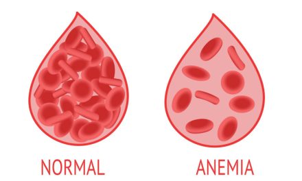 Kondisi Anemia Yang Di Alami Seseorang Akibat Kurang Darah