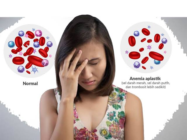 Kondisi Seorang Anemia Memiliki Beberapa Dampak