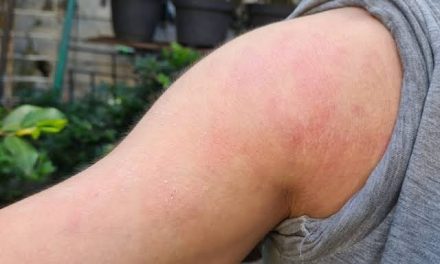 Sebuah Kondisi Kulit Yang Terkena Penyakit Eksim